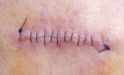Persistent Post-Surgical Pain Persistent Post-Surgical Pain