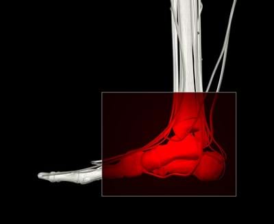 pain syndrome